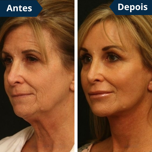 FaceLift PRO™ Redutor de Papada & Gordura Facial + Creme Aloe Vera de BRINDE